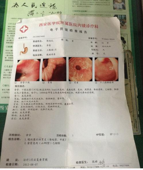 糜烂性胃炎