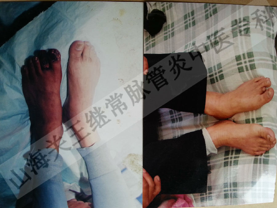 唐山闭塞性脉管炎